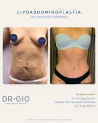 Lipoabdominoplastia con marcación abdominal